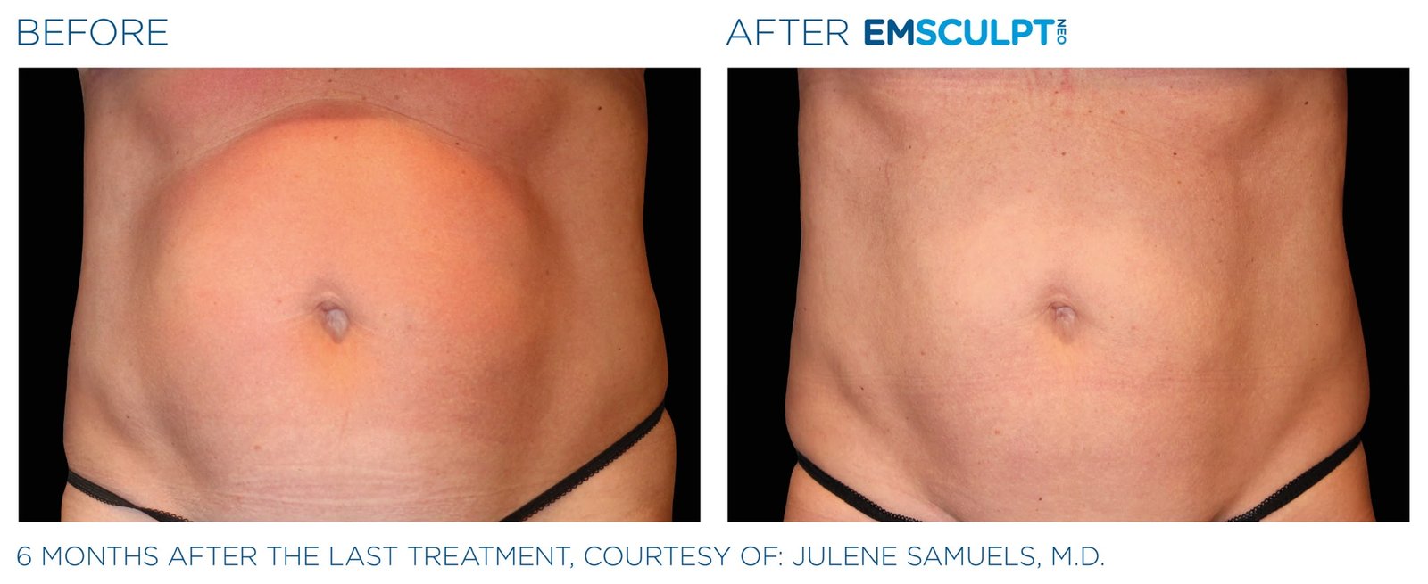Before and after Emsculpt Neo abdomen — front view, six months after final treatment