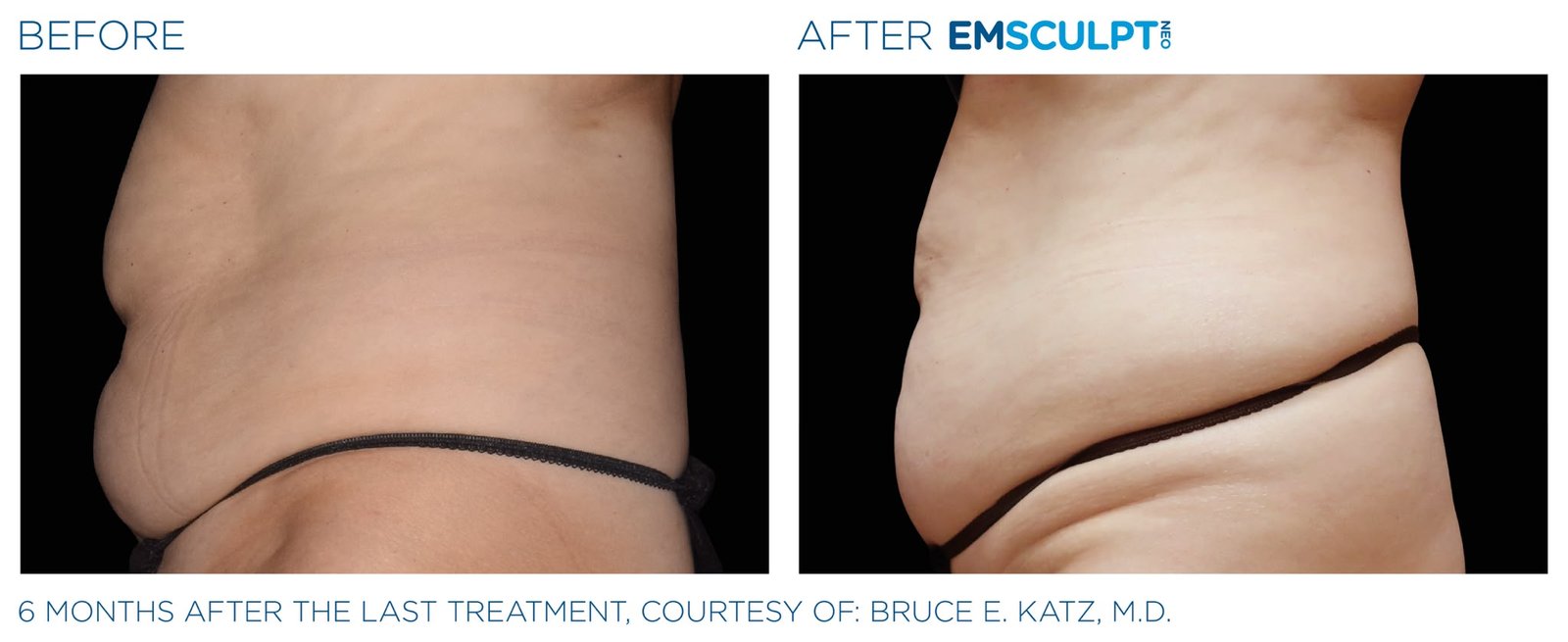 Before and after Emsculpt Neo abdominal muscle definition