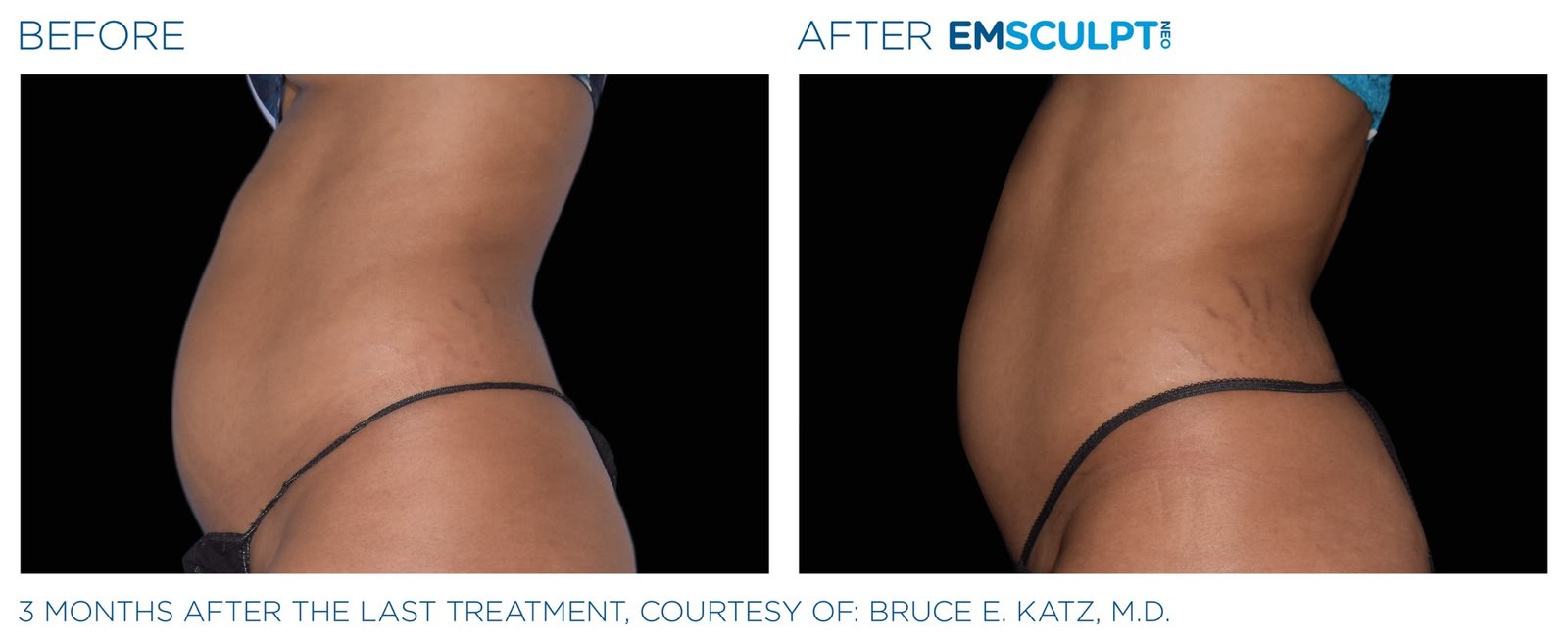 Before and after Emsculpt Neo — side profile, three months after final treatment