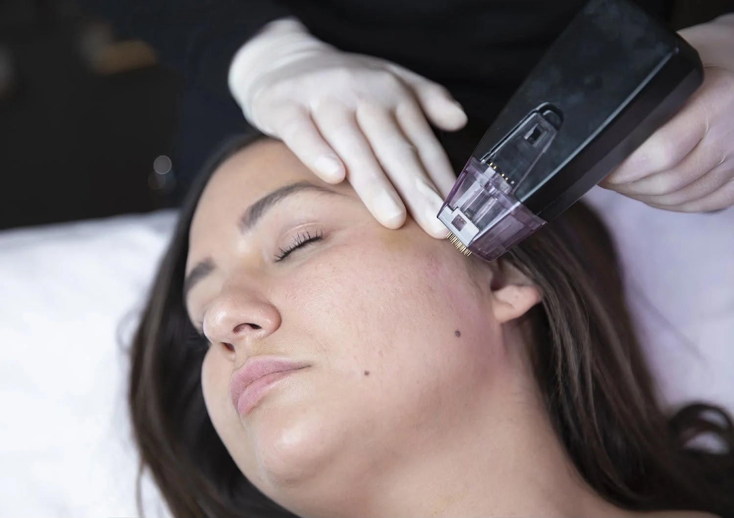 Morpheus8 radiofrequency microneedling treatment in progress at Allure Passions, Knightsbridge
